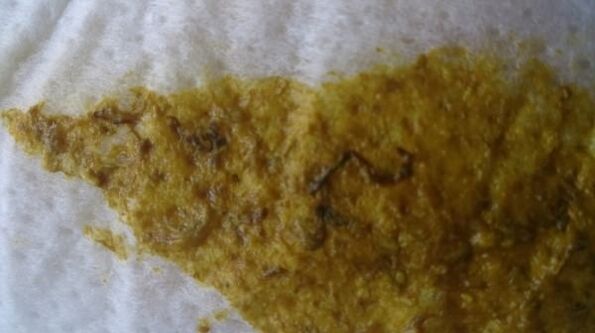 vermes en feces nun neno