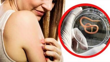 Unha erupción no corpo é un sinal de infección por helmintos